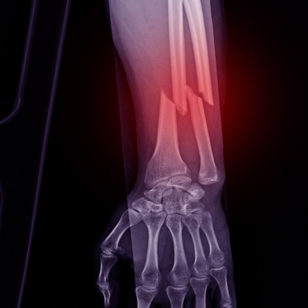 Radiografia de fratura com indicação de cirurgia de trauma ortopédico